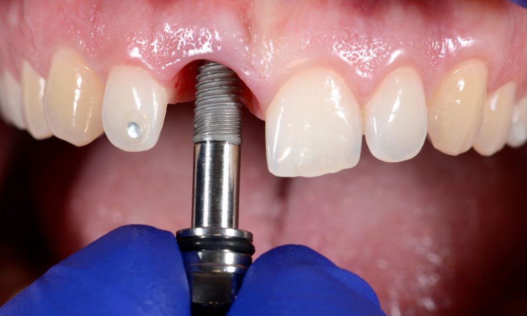 stone dental implants