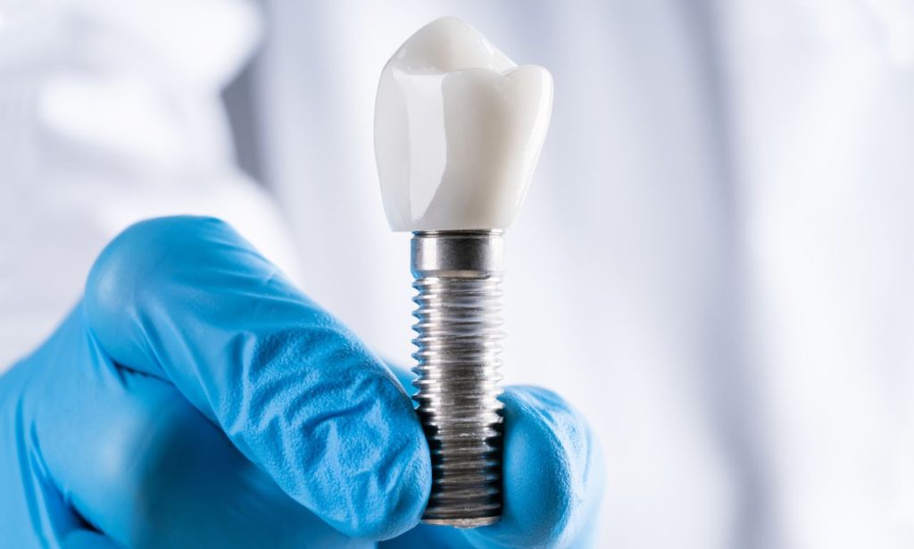 stone dental implants